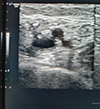 Gangrena-Fournier-4-Condilomas.JPG (37129 bytes)