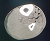 Gangrena-Fournier-4-Condilomas.JPG (37129 bytes)