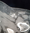 Gangrena-Fournier-4-Condilomas.JPG (37129 bytes)