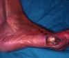Mal-Plantar-1.JPG (19112 bytes)